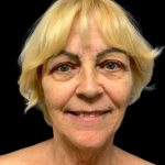 Blepharoplasty Before & After Patient #5640
