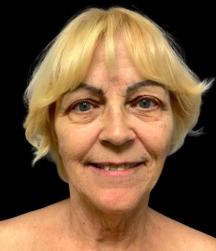 Blepharoplasty Before & After Patient #5640