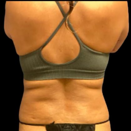 Vaser Liposuction Before & After Patient #5642