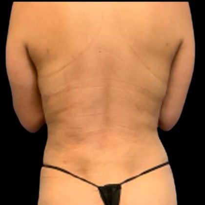 Vaser Liposuction Before & After Patient #5642
