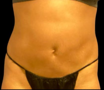 Vaser Liposuction Before & After Patient #5642