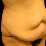 Tummy Tuck Before & After Patient #5600
