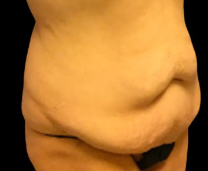 Tummy Tuck Before & After Patient #5600