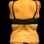 Tummy Tuck Before & After Patient #5600