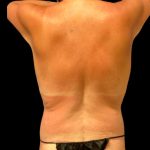 Tummy Tuck Before & After Patient #5600