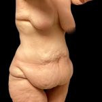 Thigh Lift Before & After Patient #5601
