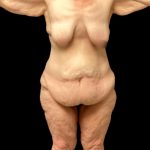 Thigh Lift Before & After Patient #5601