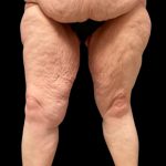 Thigh Lift Before & After Patient #5601
