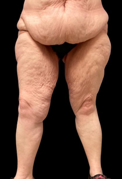 Thigh Lift Before & After Patient #5601