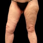 Thigh Lift Before & After Patient #5601