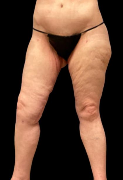 Thigh Lift Before & After Patient #5601