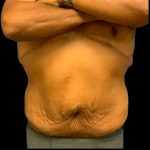 Tummy Tuck Before & After Patient #6018