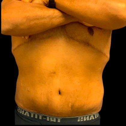 Tummy Tuck Before & After Patient #6018