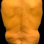 Tummy Tuck Before & After Patient #6018