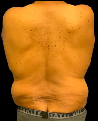 Tummy Tuck Before & After Patient #6018