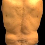 Tummy Tuck Before & After Patient #6018