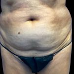 Tummy Tuck Before & After Patient #6084