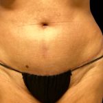 Tummy Tuck Before & After Patient #6084