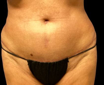 Tummy Tuck Before & After Patient #6084