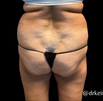 Tummy Tuck Before & After Patient #6084