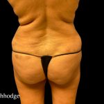 Tummy Tuck Before & After Patient #6084