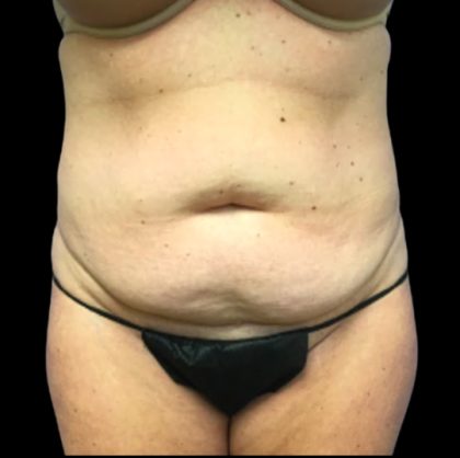 Tummy Tuck Before & After Patient #6085
