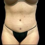 Tummy Tuck Before & After Patient #6085