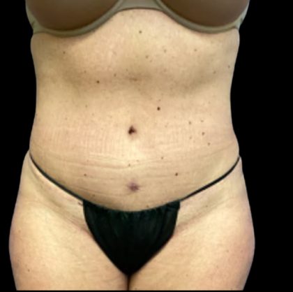 Tummy Tuck Before & After Patient #6085