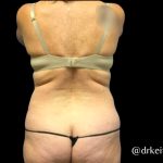 Tummy Tuck Before & After Patient #6085