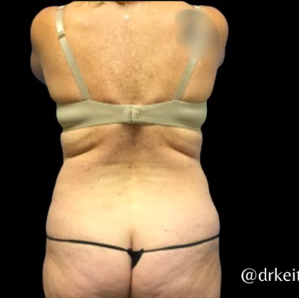 Tummy Tuck Before & After Patient #6085
