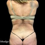 Tummy Tuck Before & After Patient #6085