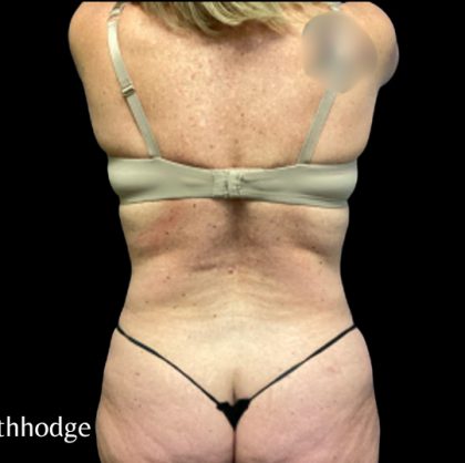 Tummy Tuck Before & After Patient #6085