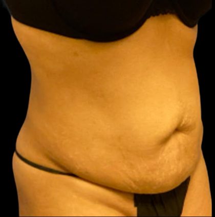 Tummy Tuck Before & After Patient #6017
