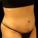 Tummy Tuck Before & After Patient #6017