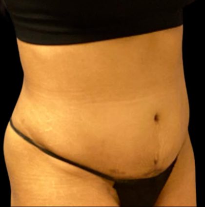 Tummy Tuck Before & After Patient #6017