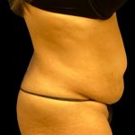 Tummy Tuck Before & After Patient #6017