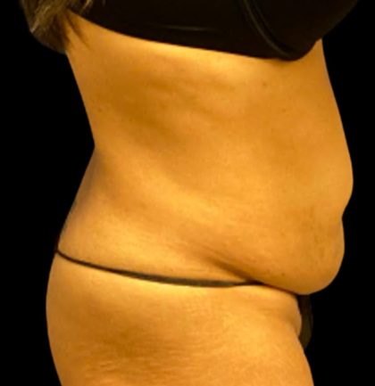 Tummy Tuck Before & After Patient #6017