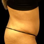 Tummy Tuck Before & After Patient #6017