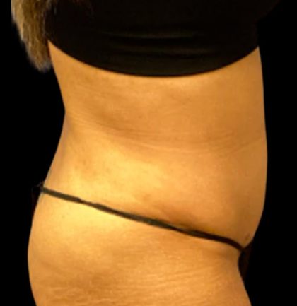 Tummy Tuck Before & After Patient #6017