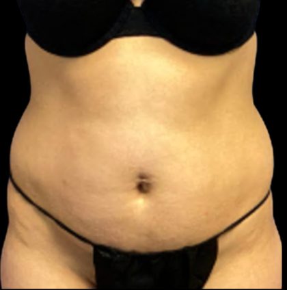 Tummy Tuck Before & After Patient #6016