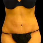 Tummy Tuck Before & After Patient #6016