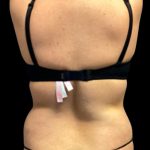 Tummy Tuck Before & After Patient #6016
