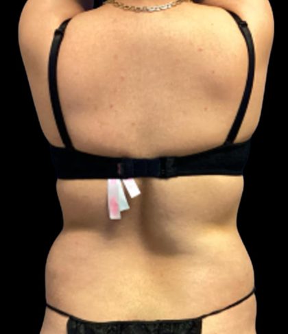 Tummy Tuck Before & After Patient #6016