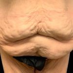 Tummy Tuck Before & After Patient #6015