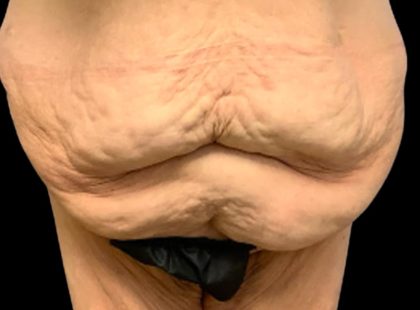 Tummy Tuck Before & After Patient #6015