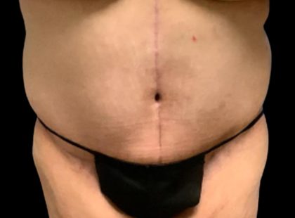 Tummy Tuck Before & After Patient #6015