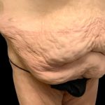 Tummy Tuck Before & After Patient #6015