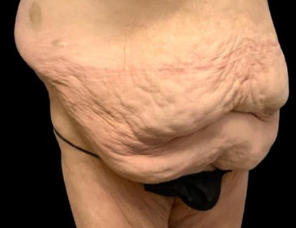 Tummy Tuck Before & After Patient #6015