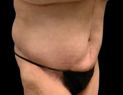 Tummy Tuck Before & After Patient #6015