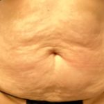 Tummy Tuck Before & After Patient #6014